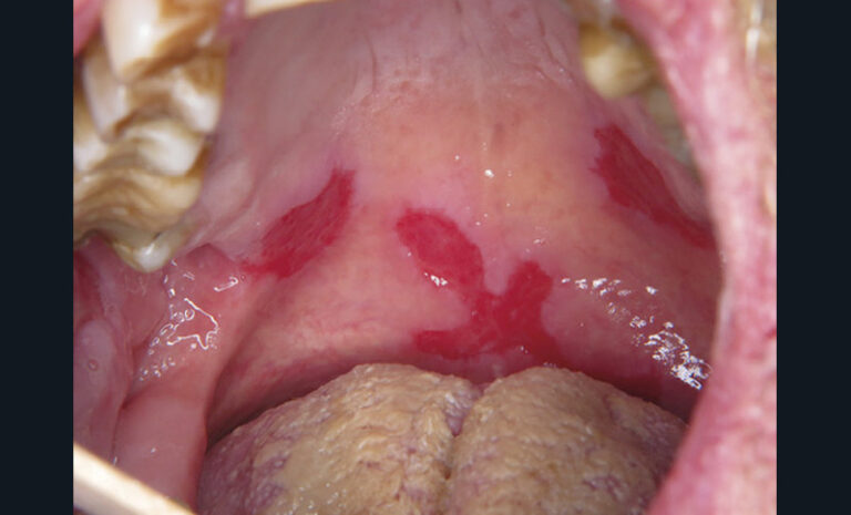 2. Érosions palatines multiples dans un pemphigus vulgaire.