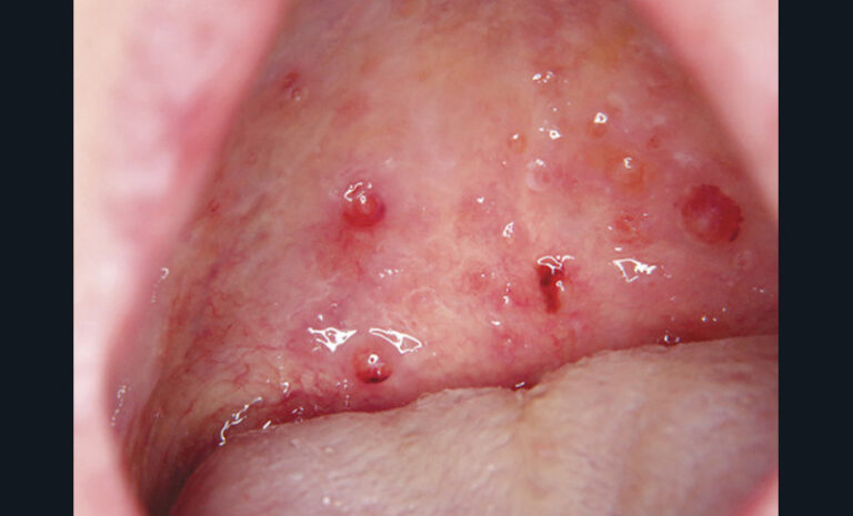5. Bulle hémorragique du pilier antérieur de l’amygdale dans une angine bulleuse hémorragique.