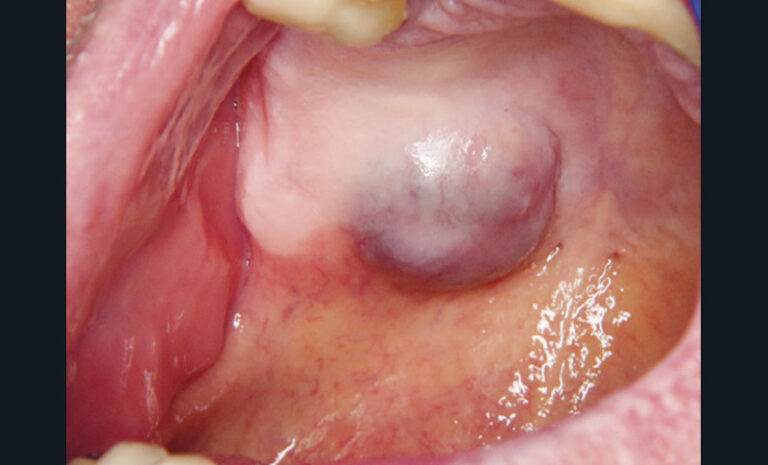 6. Nodule palatin correspondant à un carcinome mucoépidermoide kystique.