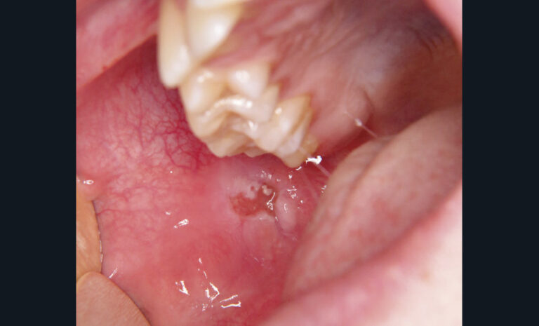 8. Ulcération traumatique secondaire au frottement de la cuspide disto-vestibulaire de la dent 17.