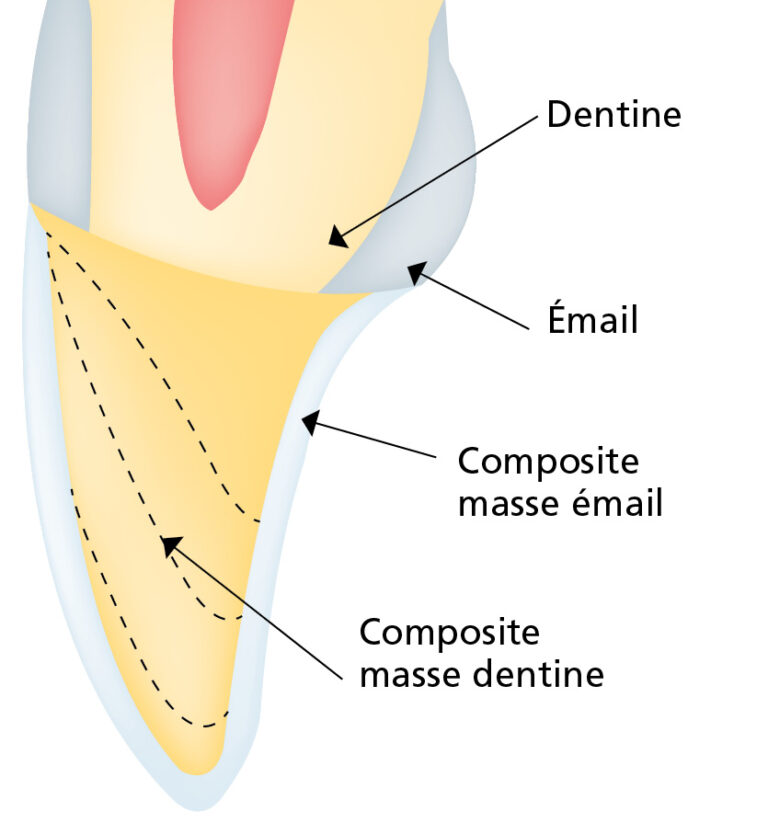 16. La masse dentine doit recouvrir une partie de l’émail vestibulaire pour cacher la transition entre la restauration et la dent.