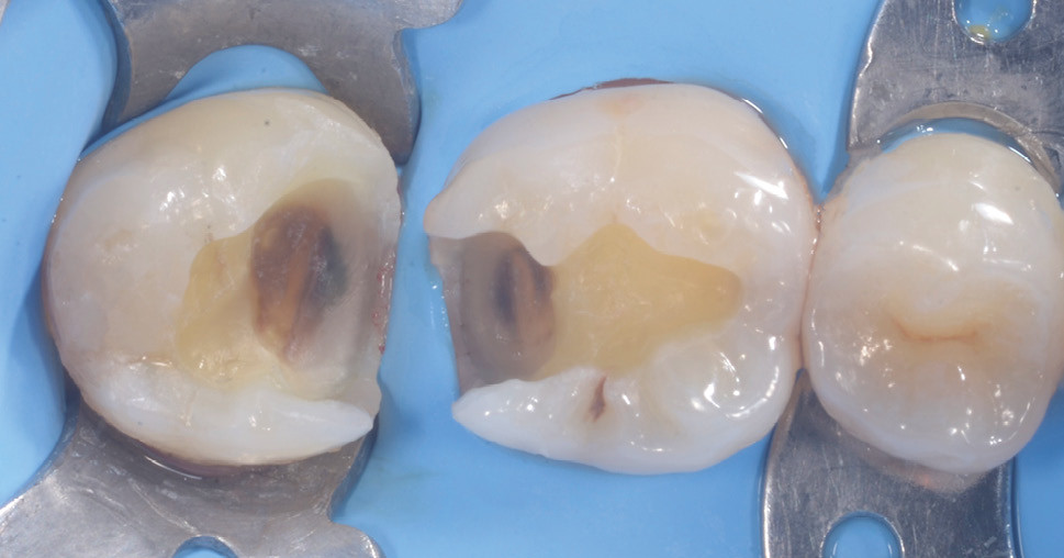 2. Les obturations défaillantes sont déposées a minima et les bords amélaires des parois résiduelles sont préservés et polis. L’analyse cavitaire confirme l’indication de deux composites directs. Les difficultés principales seront de gérer la contraction de polymérisation de la résine par la réalisation d’un fond de cavité amortisseur de contraintes et un montage par stratification et de réussir à obtenir un point de contact efficace.