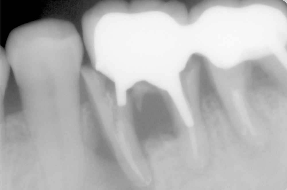 2. L’utilisation d’ancrages multiples génère une mutilation excessive, et des tensions inter-radiculaires. Les fractures radiculaires qui en résultent sont à l’origine de pertes osseuses volumineuses.