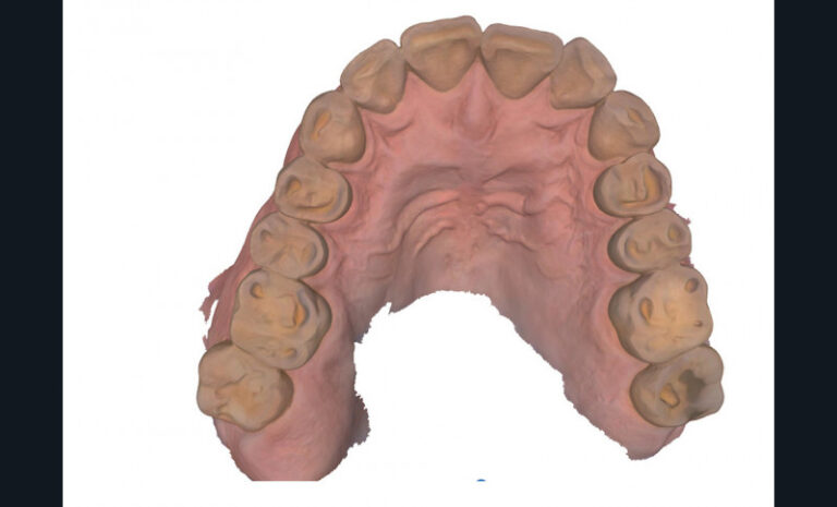 b. Vue occlusale maxillaire.