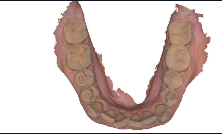 d. Vue occlusale mandibulaire.