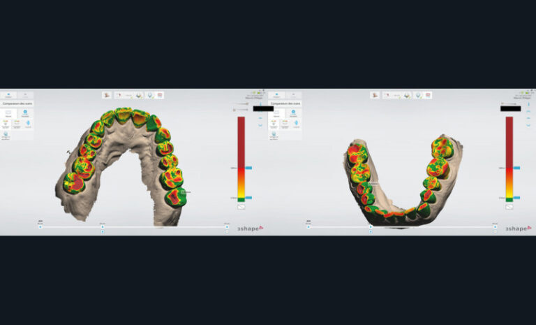 3. Comparaison des scans de 2019 et 2020 (logiciel 3Shape Patient Monitoring).