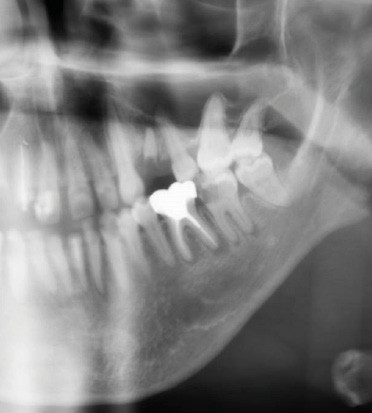 3. Patiente reçue en urgence pour des douleurs spontanées et provoquées à la mastication depuis 4 jours sur la 37. Âgée de 24 ans, elle est traitée par Remicade® (infliximab) pour une maladie de Crohn. Le traitement de la dent a été initié lors de cette consultation, sans délai de suspension du traitement particulier en raison de l’urgence infectieuse.