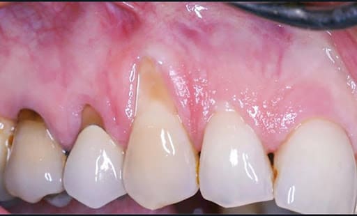 4b. Préparation pour greffe de conjonctif enfouie sous un lambeau enveloppe déplacé coronairement (20). Incisions (pointillés noirs), désépithélialisation des papilles (D), dissection en épaisseur partiel (P) apicale suivie d’un décollement en épaisseur totale (T) jusqu’à la ligne muco gingivale (LMG), puis dissection en épaisseur partielle sous muqueuse au-delà de la LMG. Le greffon est inséré au niveau des recessions et recouvert par le greffon tracté apicalement dans le sens des flèches.