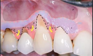 4b. Préparation pour greffe de conjonctif enfouie sous un lambeau enveloppe déplacé coronairement (20). Incisions (pointillés noirs), désépithélialisation des papilles (D), dissection en épaisseur partiel (P) apicale suivie d’un décollement en épaisseur totale (T) jusqu’à la ligne muco gingivale (LMG), puis dissection en épaisseur partielle sous muqueuse au-delà de la LMG. Le greffon est inséré au niveau des recessions et recouvert par le greffon tracté apicalement dans le sens des flèches.