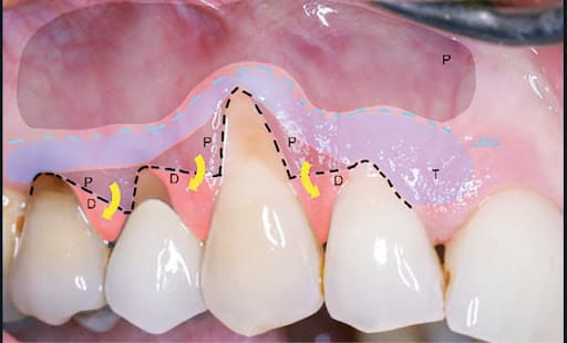 4b. Préparation pour greffe de conjonctif enfouie sous un lambeau enveloppe déplacé coronairement (20). Incisions (pointillés noirs), désépithélialisation des papilles (D), dissection en épaisseur partiel (P) apicale suivie d’un décollement en épaisseur totale (T) jusqu’à la ligne muco gingivale (LMG), puis dissection en épaisseur partielle sous muqueuse au-delà de la LMG. Le greffon est inséré au niveau des recessions et recouvert par le greffon tracté apicalement dans le sens des flèches.