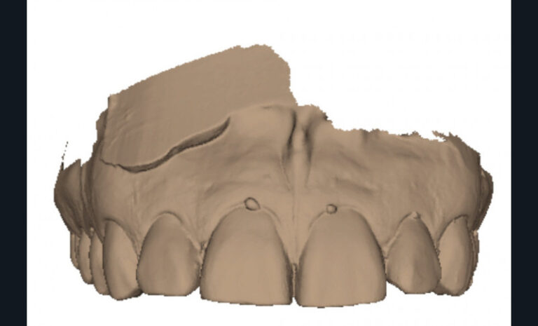 4.Numérisation des moulages du patient à la fin de son traitement orthodontique en 1988. a. Vue frontale maxillaire.