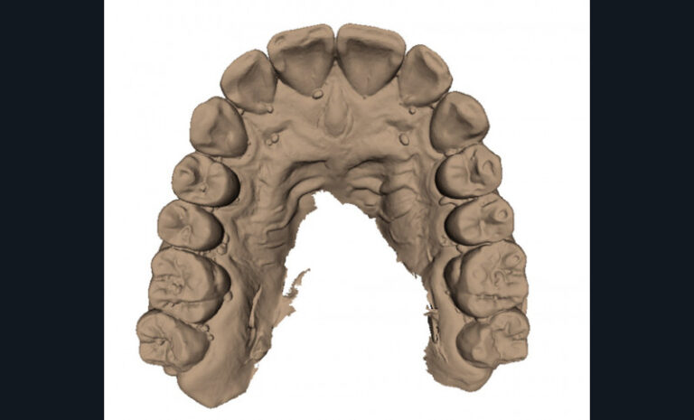 b. Vue occlusale maxillaire.