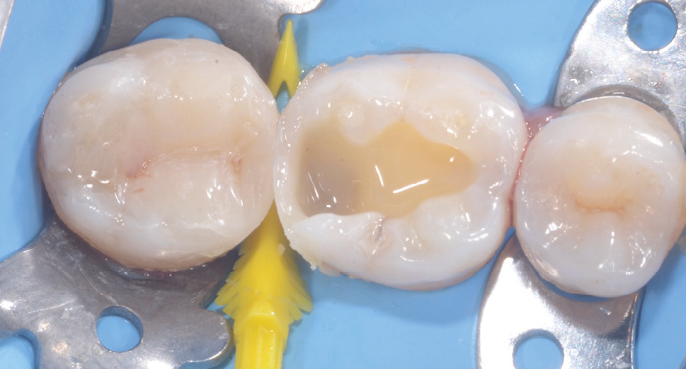 5. Après montage du composite occlusal cuspide par cuspide, le même protocole est répété sur l'autre molaire.