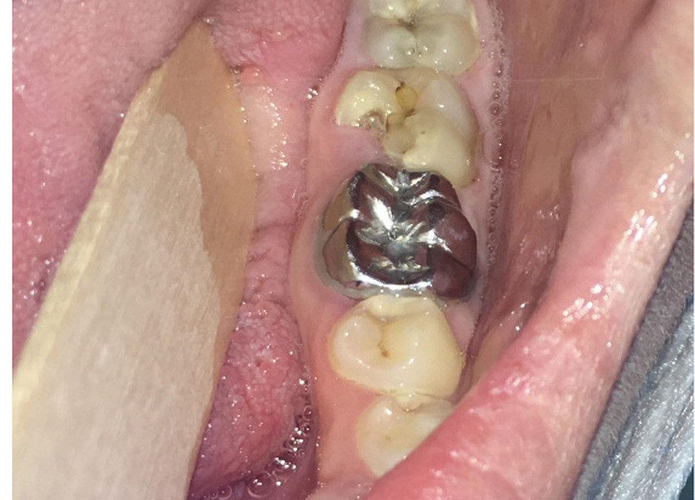 3. Patiente reçue en urgence pour des douleurs spontanées et provoquées à la mastication depuis 4 jours sur la 37. Âgée de 24 ans, elle est traitée par Remicade® (infliximab) pour une maladie de Crohn. Le traitement de la dent a été initié lors de cette consultation, sans délai de suspension du traitement particulier en raison de l’urgence infectieuse.