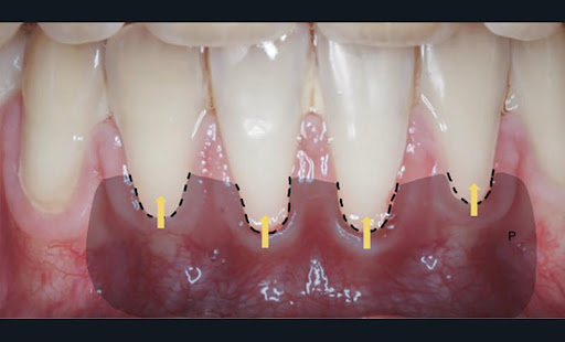 5b. Préparation pour greffe de conjonctif enfouie sous un tunnel modifié [15, 16]. Incisions intrasulculaires (pointillés noirs), préparation de l’enveloppe par dissection en épaisseur partielle au-delà de la LMG avec les décolleurs à tunnel. Insertion du greffon conjonctif et sutures avec traction apicale de l’enveloppe (flèches).