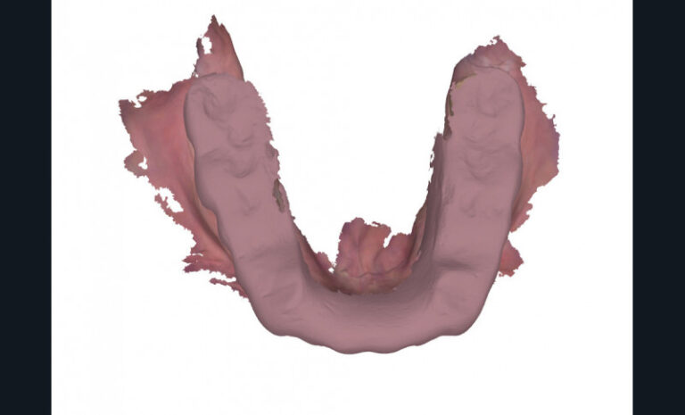 5. Empreintes optiques avec la gouttière de bruxisme en bouche. a) Vue occlusale.