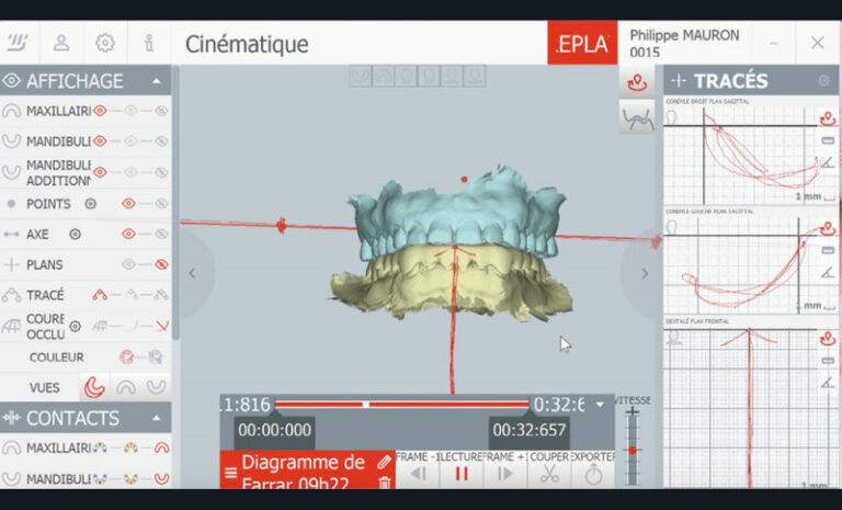 6. Enregistrements des mouvements dynamiques mandibulaires (Modjaw). a) Diagramme de Farrar.