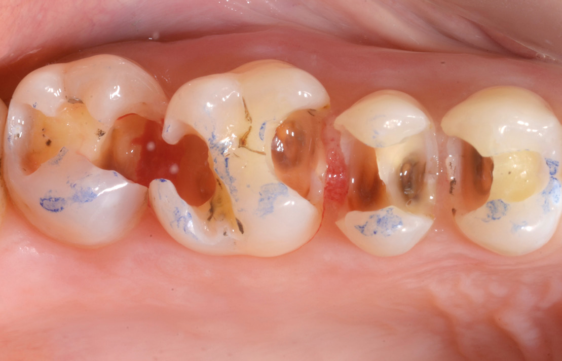 La 14 et la 17 présentent des pertes tissulaires moyennes associées à la perte d’une seule crête marginale et des parois résiduelles de plus de 2 mm d’épaisseur. Des composites directs montés par stratification pour diminuer la contraction de polymérisation peuvent être suffisants pour les restaurer. La 15, fortement délabrée, présente une douleur persistante et spontanée, qu’une thérapeutique pulpo-dentinaire n’a pas réussi à résoudre.
