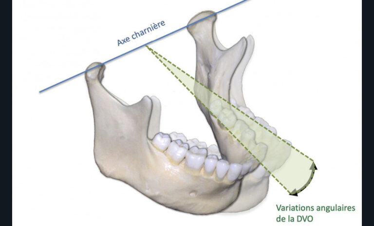 3. Les modifications de la DVO se font en Relation Centrée autour de l’axe charnière selon le mouvement axial terminal