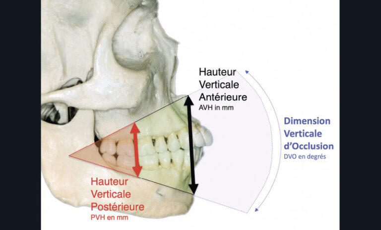 5. Pour une même DVO, on distingue la Hauteur Verticale Postérieure (HVP) et la Hauteur Verticale Antérieure (HVA).