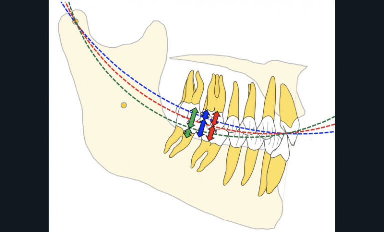 13. DVO et courbe de Spee : suivant le rayon de la courbe de Spee (bleu, rouge, vert), la hauteur verticale sera répartie différemment  entre les dents maxillaires  et les dents mandibulaires.