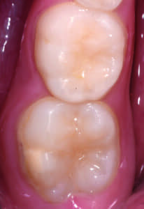 Fig. 1 - Opacité délimitée beige sur une dent n°36 dans un contexte de MIH.