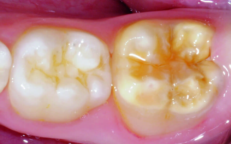 Fig. 2 - Opacité beige-jaune avec des fractures postéruptives de l’émail sur une dent n°36 dont le pronostic est rendu favorable par la présence d’une zone cervicale saine d’émail.
