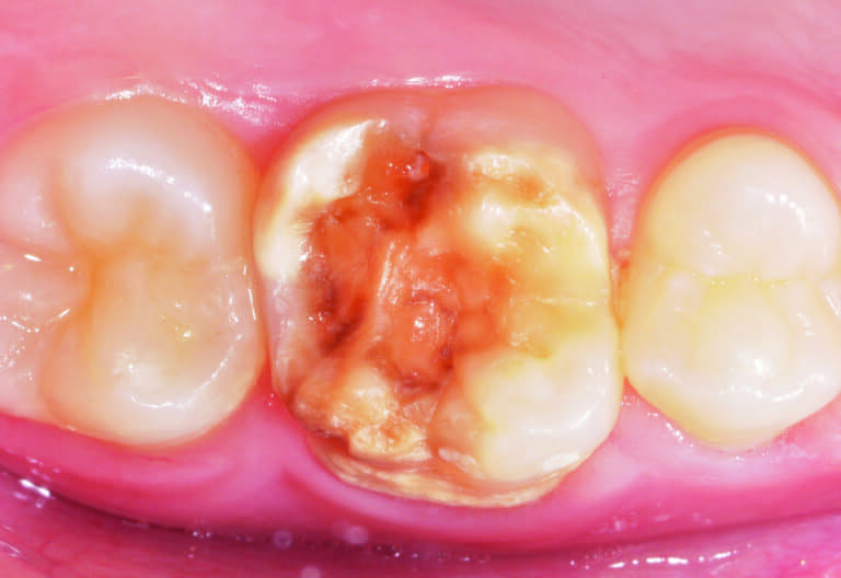 Fig. 3 - Opacité jaune-brun sur une dent n°26 dont le pronostic défavorable est aggravé par l’étendue de l’hypominéralisation incluant les deux tiers de la couronne.