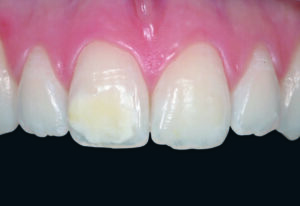 Fig. 4 - Opacité blanche sur la dent n° 11 chez un patient atteint de MIH. Les opacités de couleur blanche sont recouvertes par une couche superficielle d’émail sain. Le collage de brackets est donc de pronostic favorable.