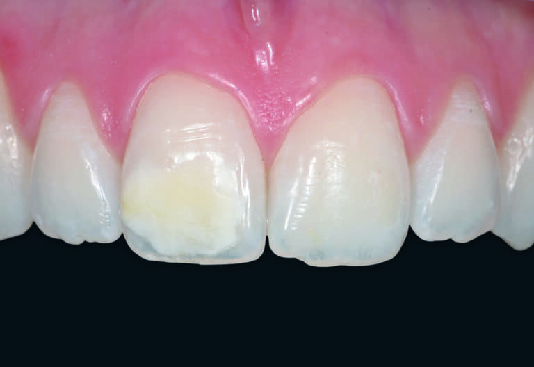 Fig. 4 - Opacité blanche sur la dent n° 11 chez un patient atteint de MIH. Les opacités de couleur blanche sont recouvertes par une couche superficielle d’émail sain. Le collage de brackets est donc de pronostic favorable.