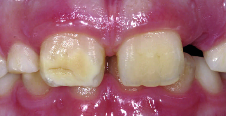 Fig. 5 - Opacité jaune-brun avec une fracture postéruptive de l’émail sur la dent n°11 chez un patient atteint de MIH. L’adhésion de cet émail hypominéralisé à des résines composites est de pronostic défavorable.