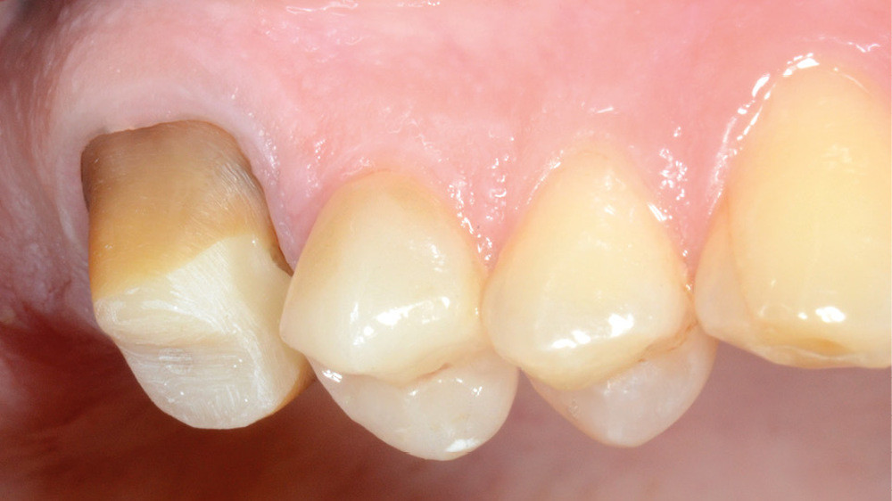 3. RMIPP de 16 par tenon fibré et composite micro-hybride dual. L’utilisation de matériaux aux modules d’élasticité proches de celui de la dentine et le recours au collage font des RMIPP une solution thérapeutique résistante et biomécaniquement favorable.