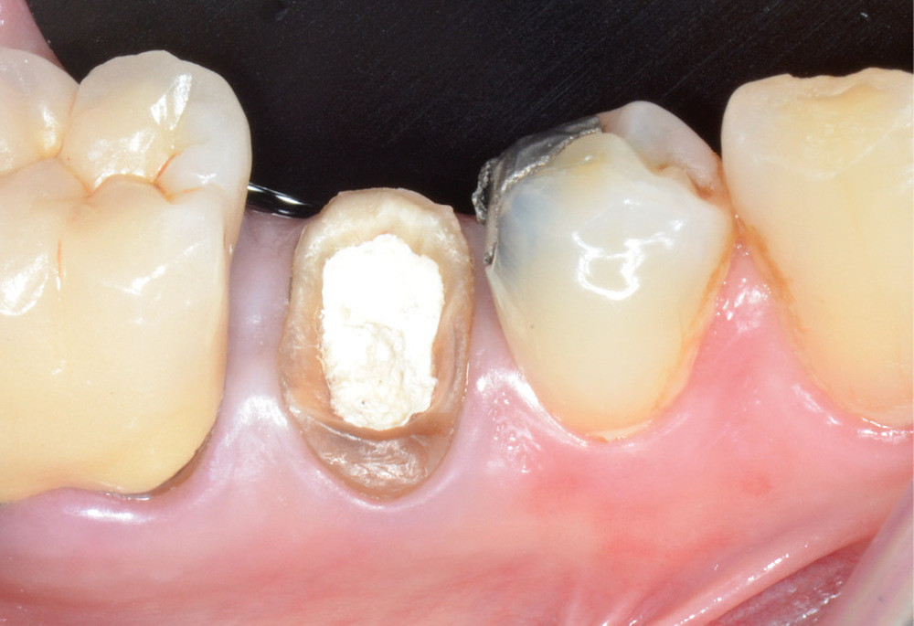 5a-c. L’utilisation de crampons adaptés et de feuilles de digue adéquates permet d’isoler la plupart des dents aux limites juxta-gingivales. Les produits de calfatage (digue chimique photopolymérisable, téflon) permettent de parfaire l’isolation.