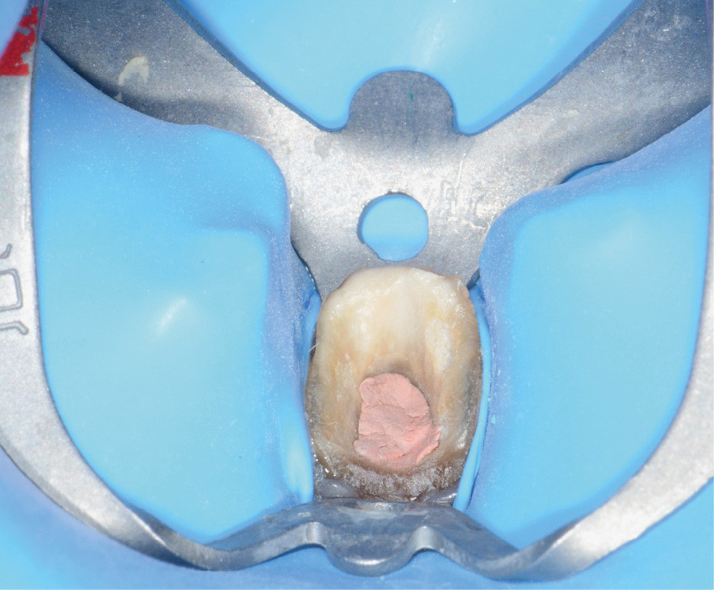 5a-c. L’utilisation de crampons adaptés et de feuilles de digue adéquates permet d’isoler la plupart des dents aux limites juxta-gingivales. Les produits de calfatage (digue chimique photopolymérisable, téflon) permettent de parfaire l’isolation.