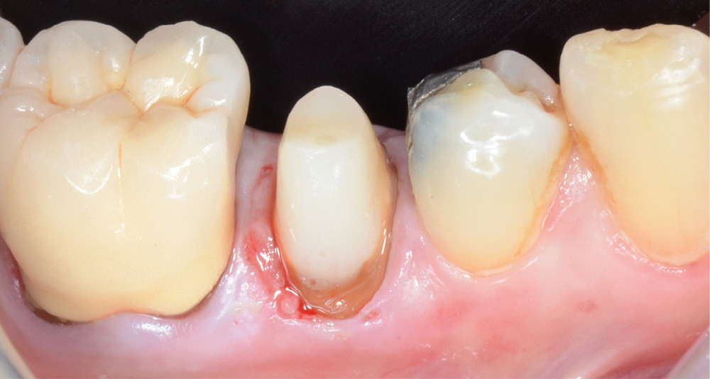 5a-c. L’utilisation de crampons adaptés et de feuilles de digue adéquates permet d’isoler la plupart des dents aux limites juxta-gingivales. Les produits de calfatage (digue chimique photopolymérisable, téflon) permettent de parfaire l’isolation.