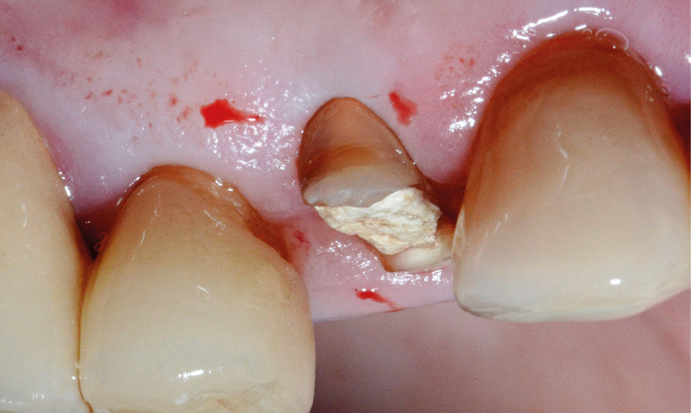 Couronne En Résine Pour Le Traitement Temporaire, Qui Sont Utilisés Dans  Les Cas Où Le Patient Doit Repartir Avec Les Dents Meulé Du Dentiste.  Ceux-ci Ont Un Rôle Protecteur Sur Les Dents