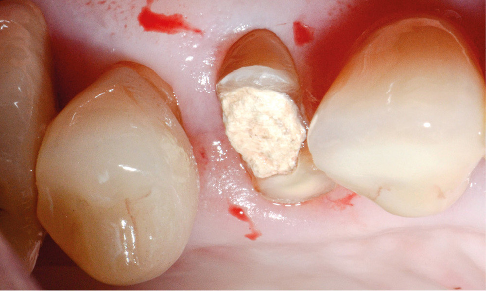 6a-b. État initial de 14 après fracture coronaire. Les critères de choix de la RCR basés sur le nombre de parois résiduelles indiquent la réalisation d’un inlay-core.