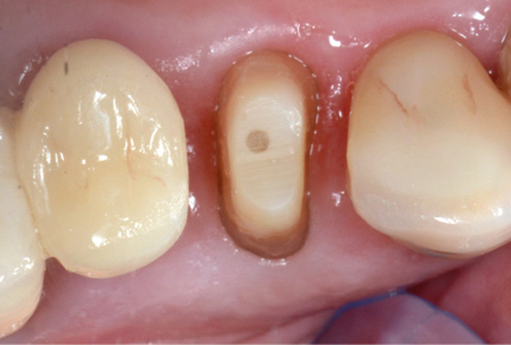 e. Vue occlusale de 14 à une semaine post-RMIPP. La temporisation par une prothèse transitoire permet un remodelage gingival propice à la délimitation de limites cervicales précises.