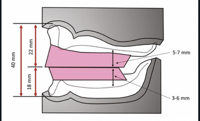 4. Hauteurs standardisées des maquettes d’occlusion et des bourrelets maxillaire et mandibulaire.