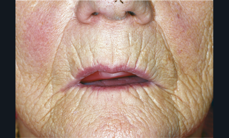 8. Découvrement important du bourrelet antérieur par rapport à la lèvre supérieure.