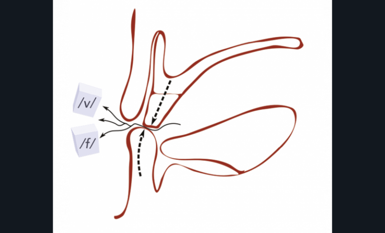 10. Coupe sagittale de la cavité orale avec positionnement de la lèvre inférieure sous le bourrelet antérieur lors de la prononciation des phonèmes /f/ (« feu ») et /v/ (« veu »).