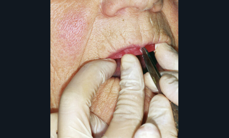 12. Marquage du milieu inter-incisif sur le bourrelet maxillaire à l’aide du couteau à cire.