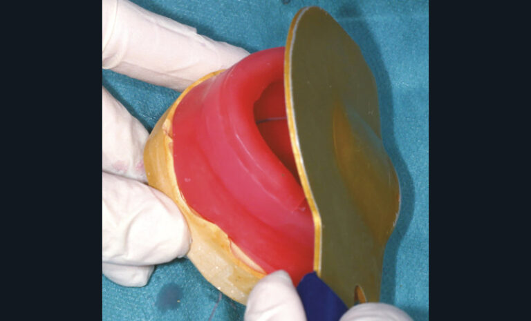14. Utilisation de la cuillère de Schreinemakers pour prérégler les secteurs postérieurs du bourrelet maxillaire.
