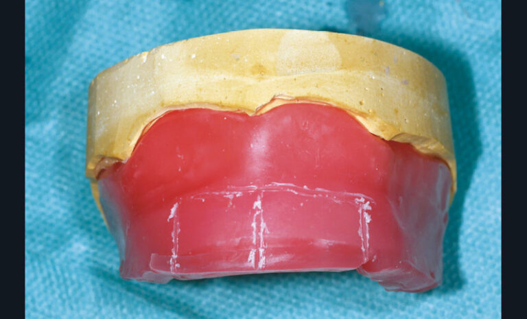 16. Maquette maxillaire réglée et marquée par les indices esthétiques.