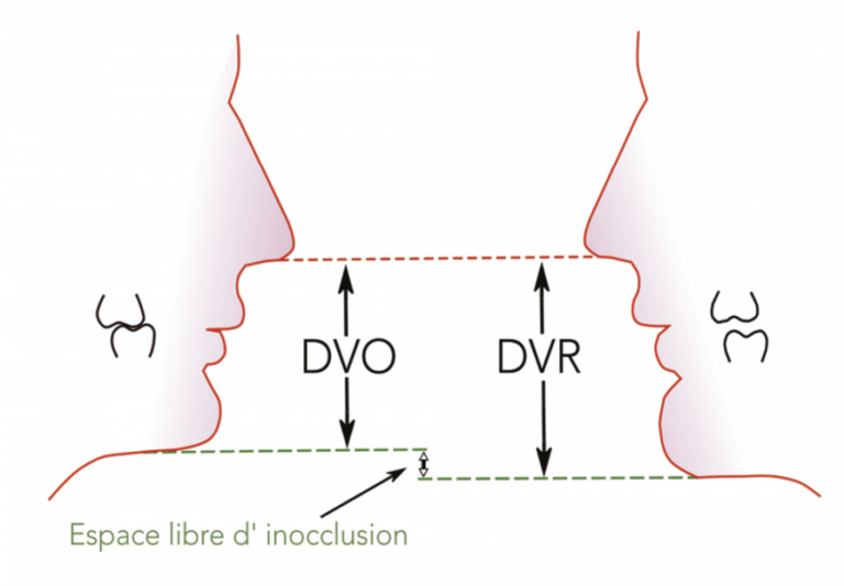 17. Espace libre d’inocclusion différenciant la dimension verticale de repos (DVR) de la dimension verticale d’occlusion (DVO).