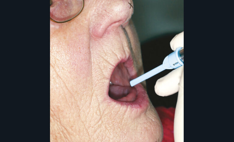 22. Apport d’eau sur la langue de la patiente avant le test de déglutition.
