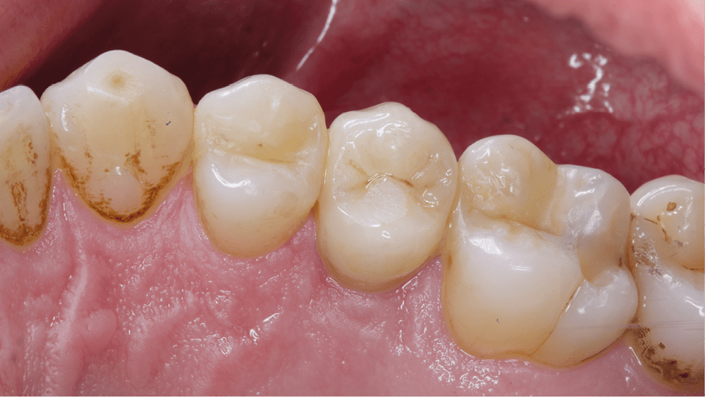 11. Vue postopératoire à 7 jours post-collage : Le placement des limites prothétiques en supra-gingival favorise la cicatrisation parodontale.