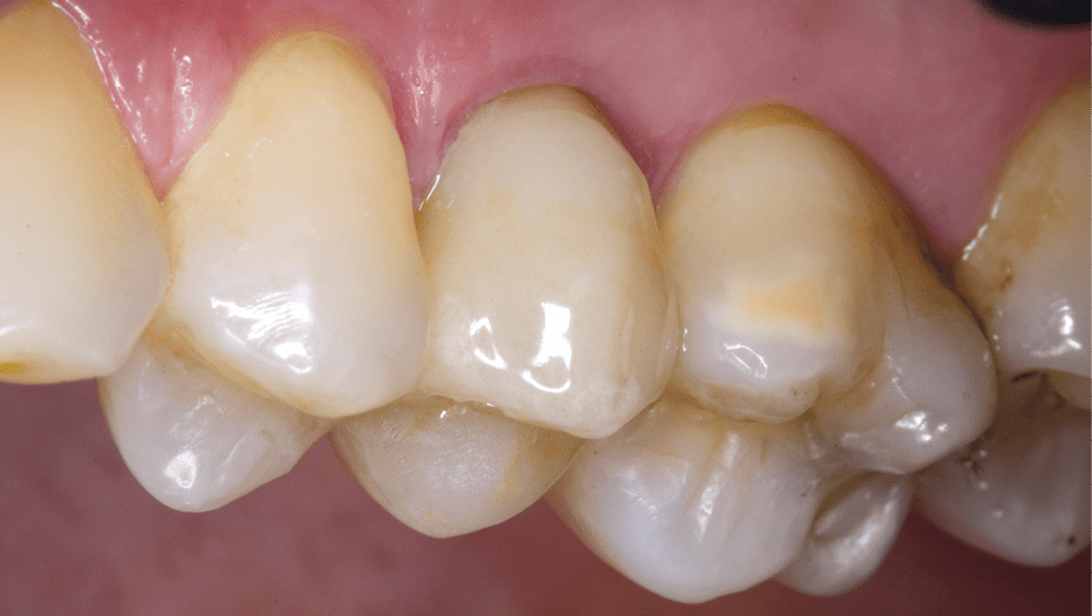 12. Intégration esthétique satisfaisante sur 25, malgré la limite supra-gingivale.