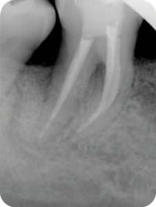 Radiographie contrôle à 4 ans