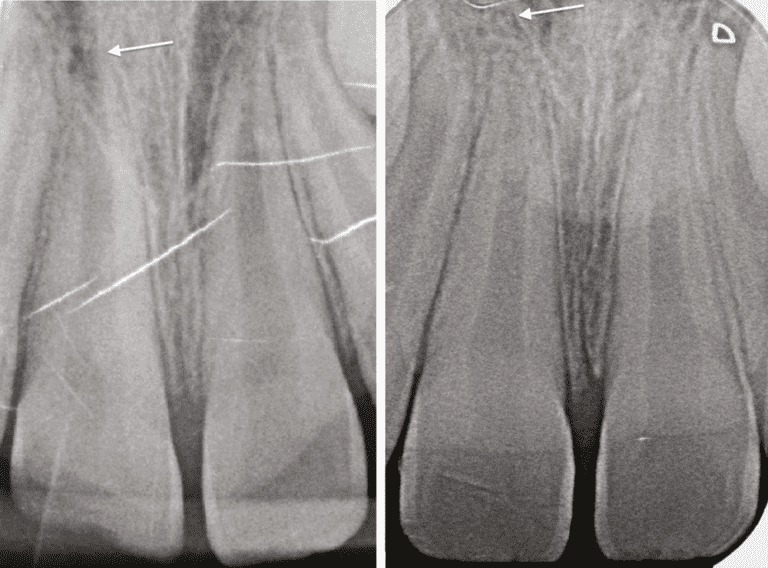 2. a.Radiographie initiale. La flèche pointe l’apex de la 11 en cours de maturation. b. Radiographie à un an. La flèche pointe une racine mature apexifiée.